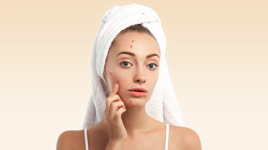 Gentle summer skincare routine for breakout-prone skin