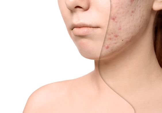 Acne Scars: How to Fade Them for Clear, Spotless Skin? Elmore