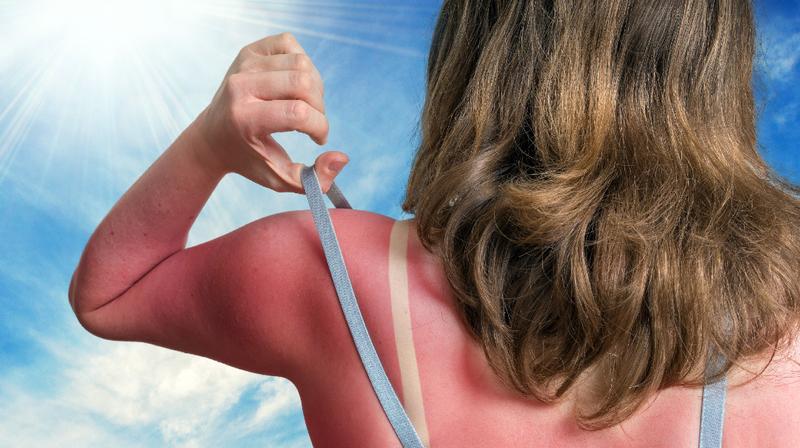 Gentle after-sun skincare for mild sunburned skin