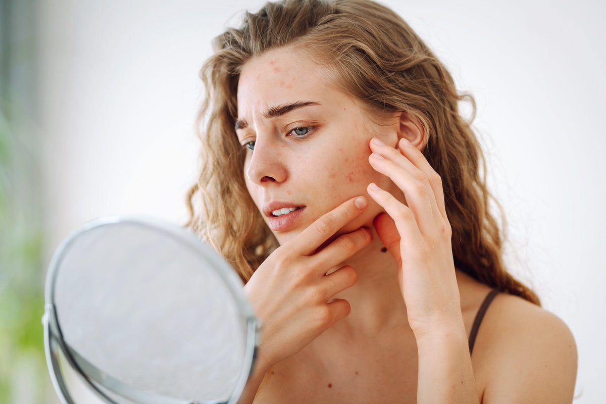 Balanced summer skincare routine for breakout-prone skin