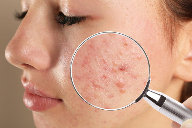 Acne & breakouts